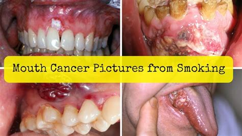 Mouth Cancer Pictures from Smoking   Oral Cancer Symptoms ...