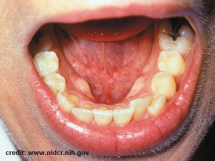 mouth cancer symptoms | Oral Cancer Help