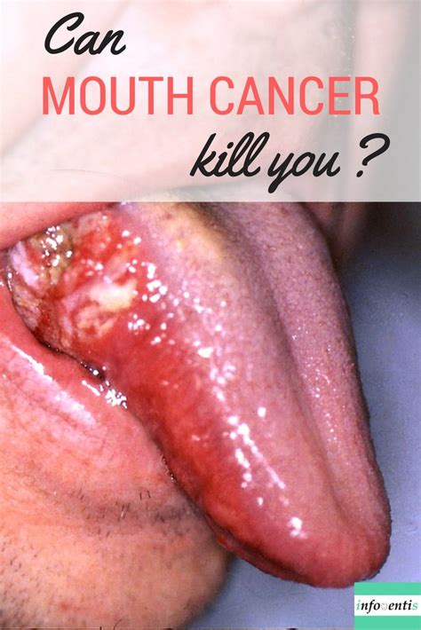 Mouth cancer, the quick patient s guide