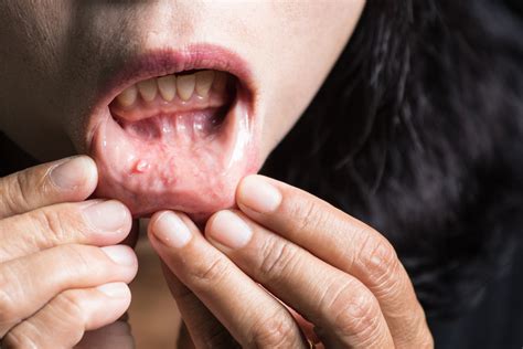 Mouth / Oral Cancer: Types, Symptoms, Causes, Risks ...