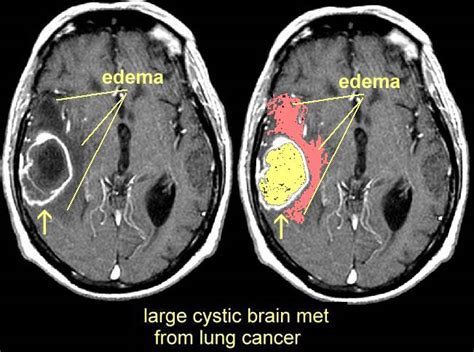 MRI Images of Brain Mets