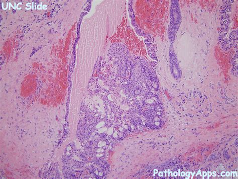 mucoepidermoid carcinoma pathology