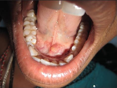 Multiple bilateral submandibular gland sialolithiasis ...