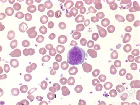 Myelofibrosis: peripheral blood   4.