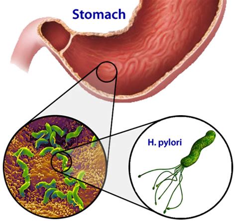Natural H. Pylori Treatment and a Brief Overview of its ...