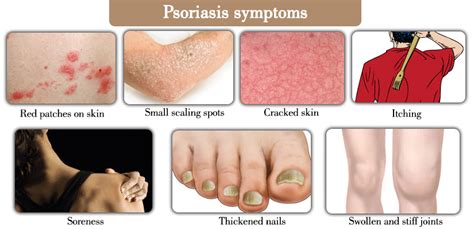 Natural Remedies for Psoriasis   Holistic Health