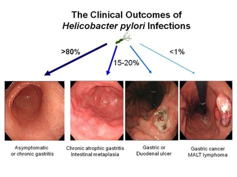 Natural remedies for treatment helicobacter pylori ...