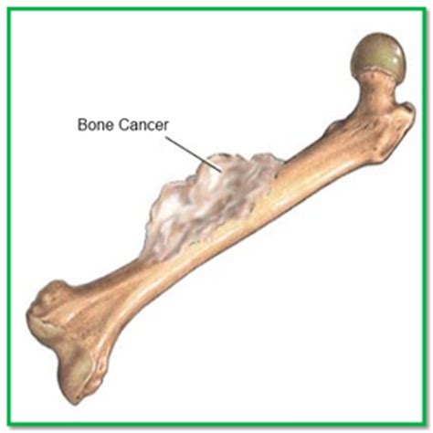 Natural Treatment of Bone Cancer | Ayurvedic Medicines ...