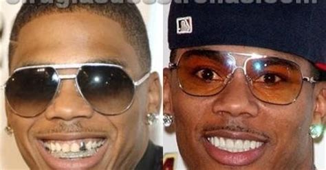 Nelly antes y después Cirugías de estrellas