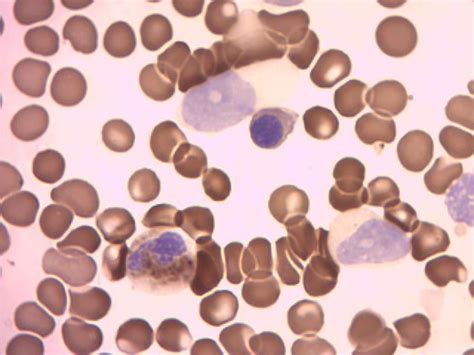 Neoplasia de células dendríticas blásticas plasmocitoides ...
