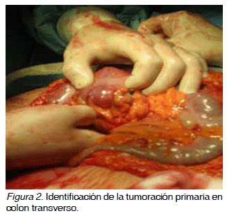 Neoplasias Peritoneales