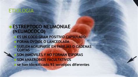 Neumococo etiologia patologia diagnostico diagnostico ...