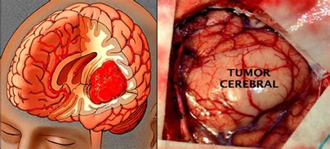 Neuro   Crânio & Coluna   Tumor Cerebral