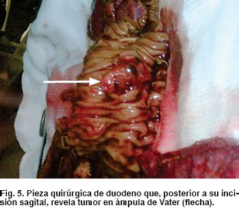 Neuroendocrine tumors of the pancreas appearing as ...