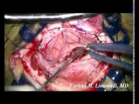 Neurosurgery : Removal of GBM  Glioblastoma Multiforme ...
