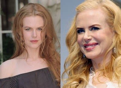 Nicole Kidman cirugia estetica   Nicole Kidman antes de ...