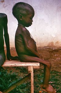 nicoleee: niños desnutridos en africa