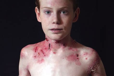 Niño con enfermedad de la piel de mariposa inspira | ABC