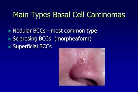 Nodular Basal Cell Carcinoma