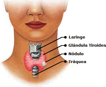 Nódulos Tiroideos: Síntomas de Nódulos en Tiroides | TuChequeo