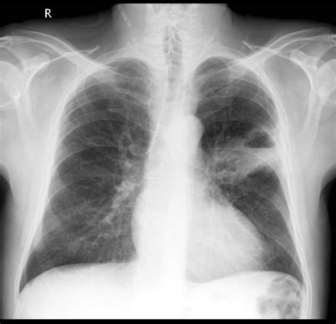 Non small cell lung cancer chest x ray   wikidoc