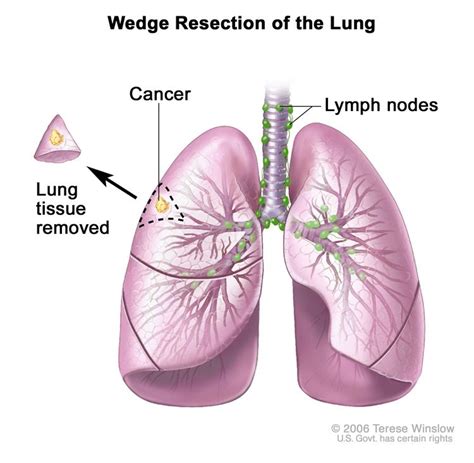 Non Small Cell Lung Cancer Treatment  PDQ® —Patient ...