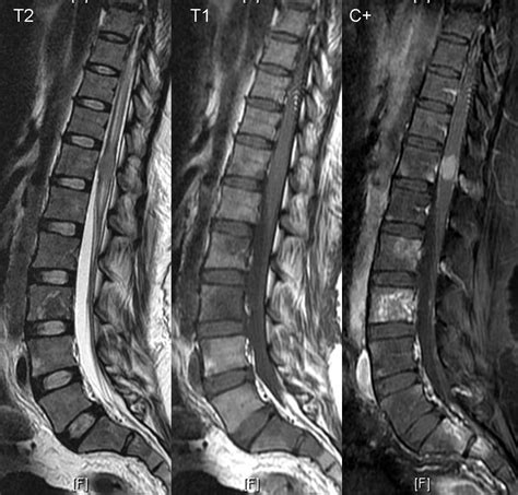 Normal MRI Lumbar Spine