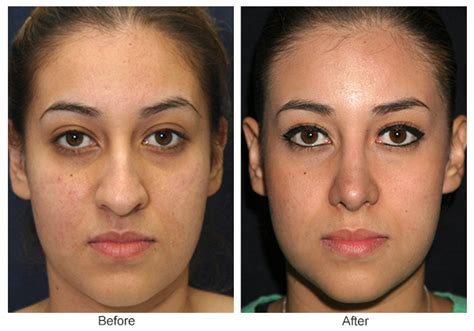 Nose Plastic Surgery Before And After | The Art Of Beauty