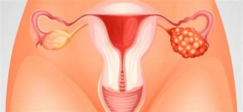 Nueva investigación sobre cáncer de ovario   Catalunya ...