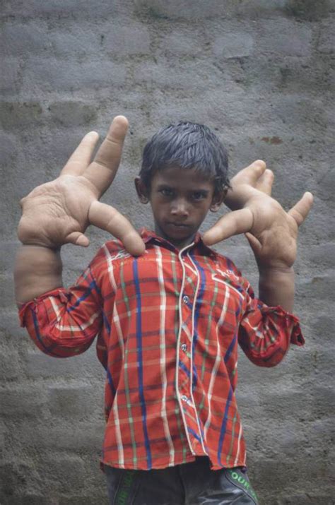 O estranho caso do garoto indiano com mãos gigantes que ...