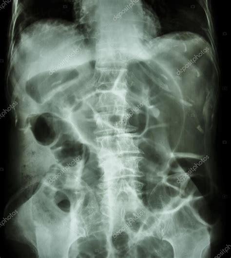 Obstrucción intestinal posición decúbito dorsal del ...