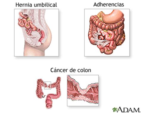 Obstrucción intestinal Serie: MedlinePlus enciclopedia ...