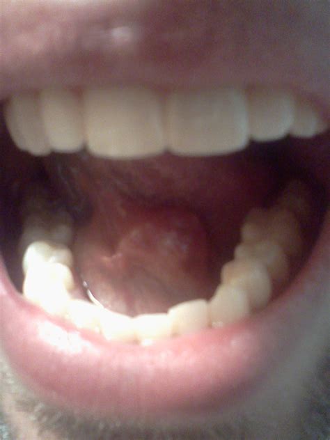 On my salivary gland | Ramble On