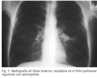 Opiniones de Carcinoma pulmonar no microcítico