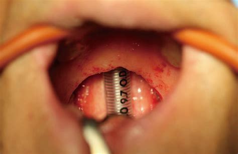 Oral Cancer as related to Soft Palate   Pictures