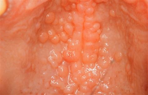Oral Cancer as related to Soft Palate   Pictures