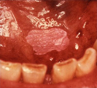 Oral Cancer   Causes, Symptoms, Treatment, Pictures, Signs ...