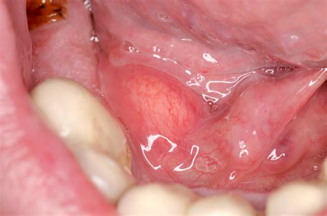 Oral Cancer Floor Of Mouth | www.pixshark.com   Images ...