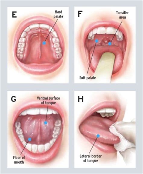 Oral Cancer Screening Examination   Pearly Whites Plus