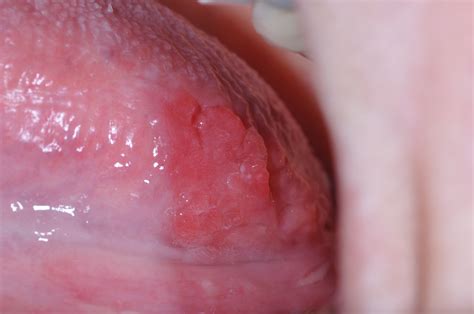 Oral cancer signs and symptoms