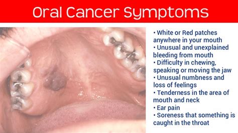 Oral cancer symptoms | Health and Fitness
