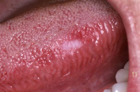 Oral Cancer Symptoms  Signs To Know   Dentist Says