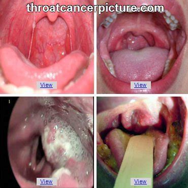 Oropharyngeal Cancer   Throat Cancer Pictures | Kimaja ...