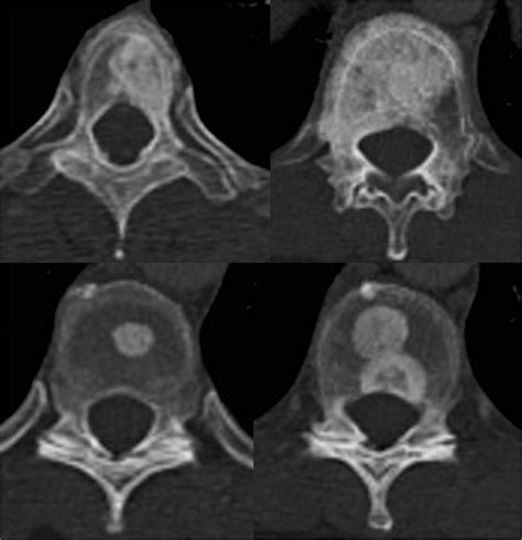 Osteoblastic bone metastases from breast cancer | Image ...