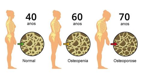 Osteoporose: Conheça melhor esta doença | Mulher Portuguesa