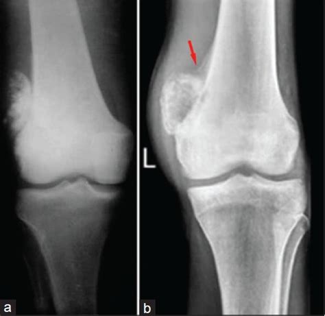 osteosarcoma knee Gallery