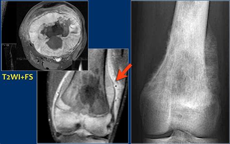 Osteosarcoma Knee Tumor | www.imgkid.com   The Image Kid ...