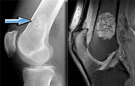 Osteosarcoma Knee Tumor | www.imgkid.com   The Image Kid ...