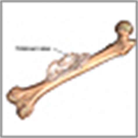 Osteosarcoma: MedlinePlus enciclopedia médica