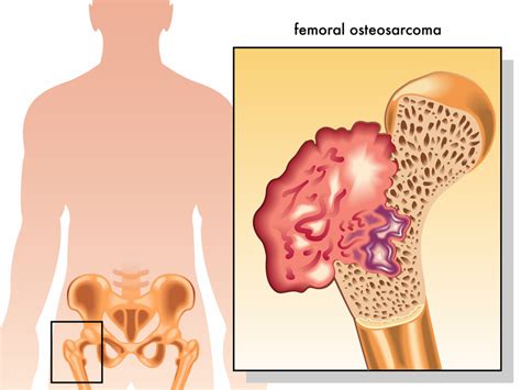 Osteosarcoma Symptoms May Point to a Rare Type of Cancer ...